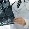 White matter damage can trigger neurodegeneration-like features, study