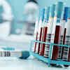 Blood test could help detect signs of Alzheimer's disease decades before symptoms